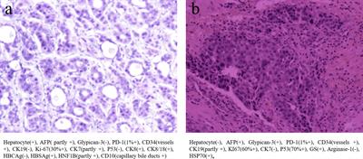 Advanced hepatocellular carcinoma with MET-amplified contained excellent response to crizotinib: a case report